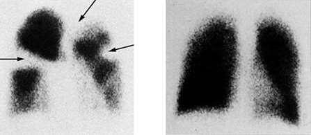Diagnosis Ventilation perfusion Scintigraphy An abnormal nuclear lung scan shows areas without nuclear particles (arrows).