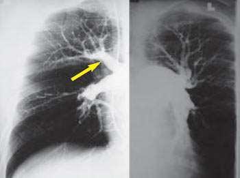 Diagnosis Pulmonary angiography as the gold standard' for the diagnosis or exclusion of PE Organized thrombi appear as unusual filling defects, webs, or bands, or