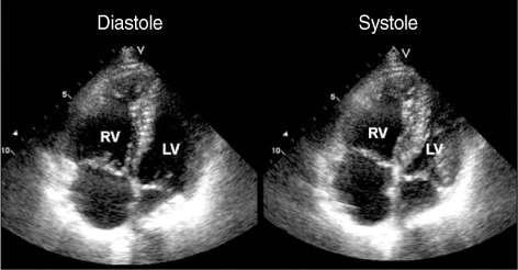 Diagnosis Echocardiography Signs A patient with acute pulmonary thromboembolism.