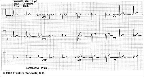 Figure 5: An example of a normal 12-lead ECG 2.4 Response to exercise The goal of this part of the lab is to record the response of a test subject to moderate exercise.