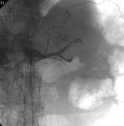 Renal cell carcinoma (RCC) Embolization: Possible
