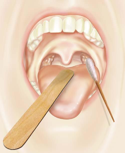 Procedure Throat Swab Procedure Throat Swab The patient may gag during the procedure so depress the tongue gently with the tongue depressor to prevent it from contaminating the swab when being