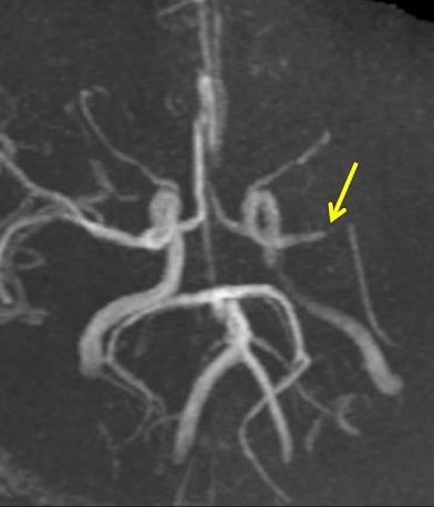 occlusion in the parent artery or From