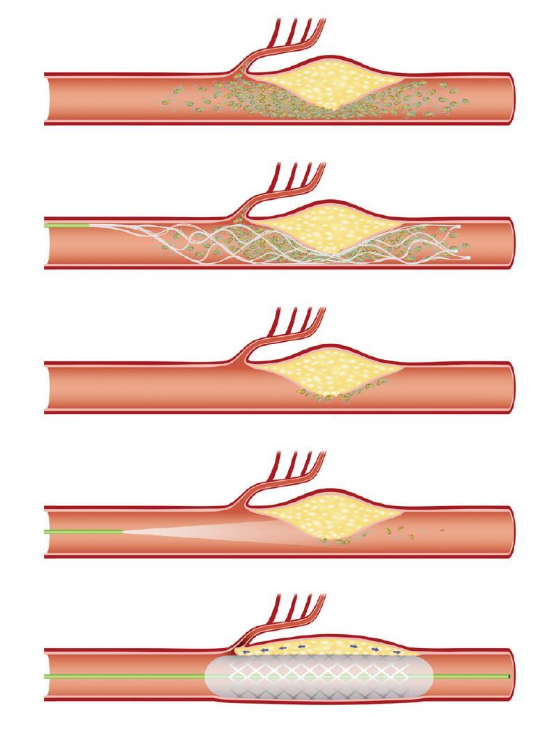 Stent retrieval for ICAS-O. Routine firstline thrombectomy can effectively eliminate the major portion of in situ thrombi.