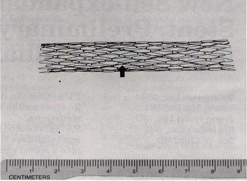 diameter, and the length wart variable. The stent was construected with only one wire, without use of silver solder or suture for connection.