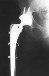 6%), and in both the acetabulum and the femur in one patient (6.6%), and cancellous allografts were used for coverage of these defects.