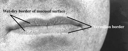 150 Practical Plastic Surgery for Nonsurgeons Mucosal Lacerations Important anatomic landmarks of the lip. The key to successful repair is to realign the wet-dry mucosal border, as explained above.