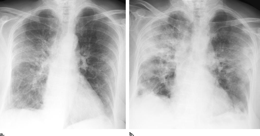 562 March-April 2004 RG f Volume 24 Number 2 Figure 9. SARS in a 73-year-old woman who presented 17 days after exposure. The chest radiograph obtained on admission (not shown) was normal.