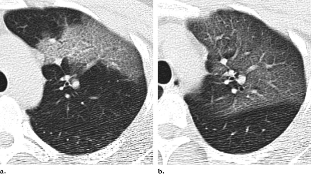 558 March-April 2004 RG f Volume 24 Number 2 Figure 3. SARS in a 38- year-old male healthcare worker in whom initial chest radiography at admission depicted no abnormality.