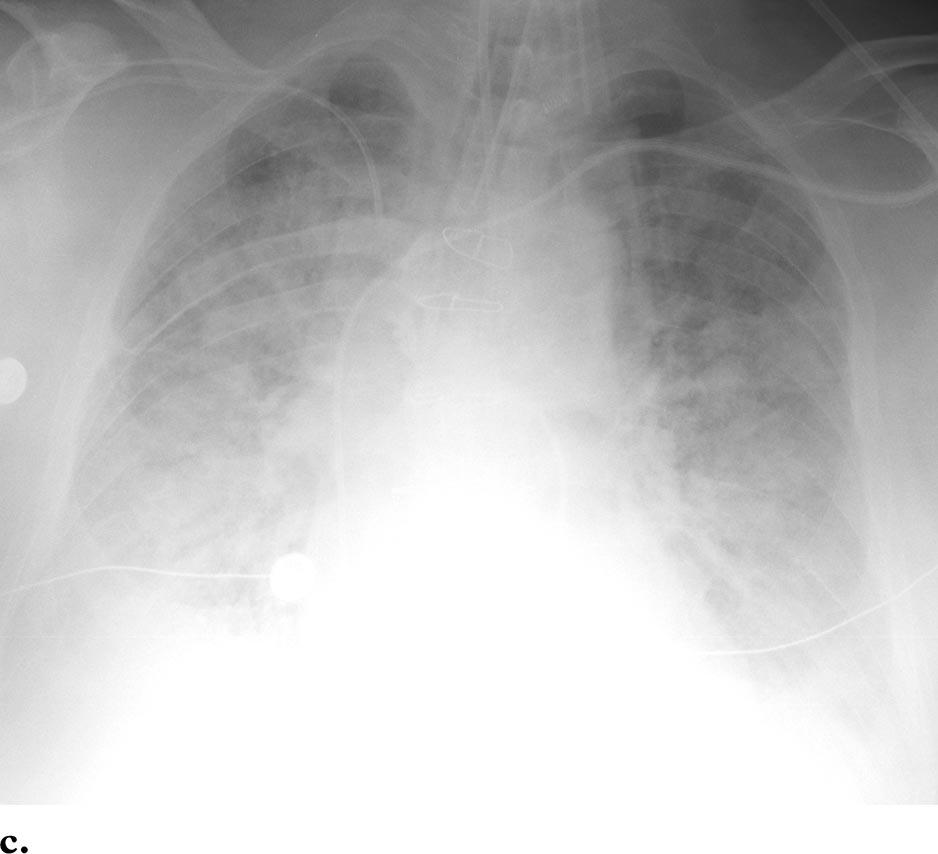 (b) Anteroposterior radiograph obtained 5 days later shows a resolution of consolidation in the left lung but increased consolidation in the right lung.