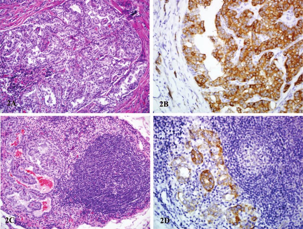 Figure 2. A through D, Immunohistochemical detection of BRAF expression in a papillary thyroid microcarcinoma and its metastasis in a lymph node, using anti-ve1 antibody.