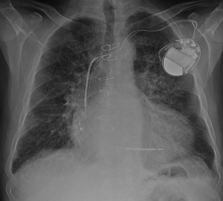 pulmonary vasculature : Pulmonary interstitial edema