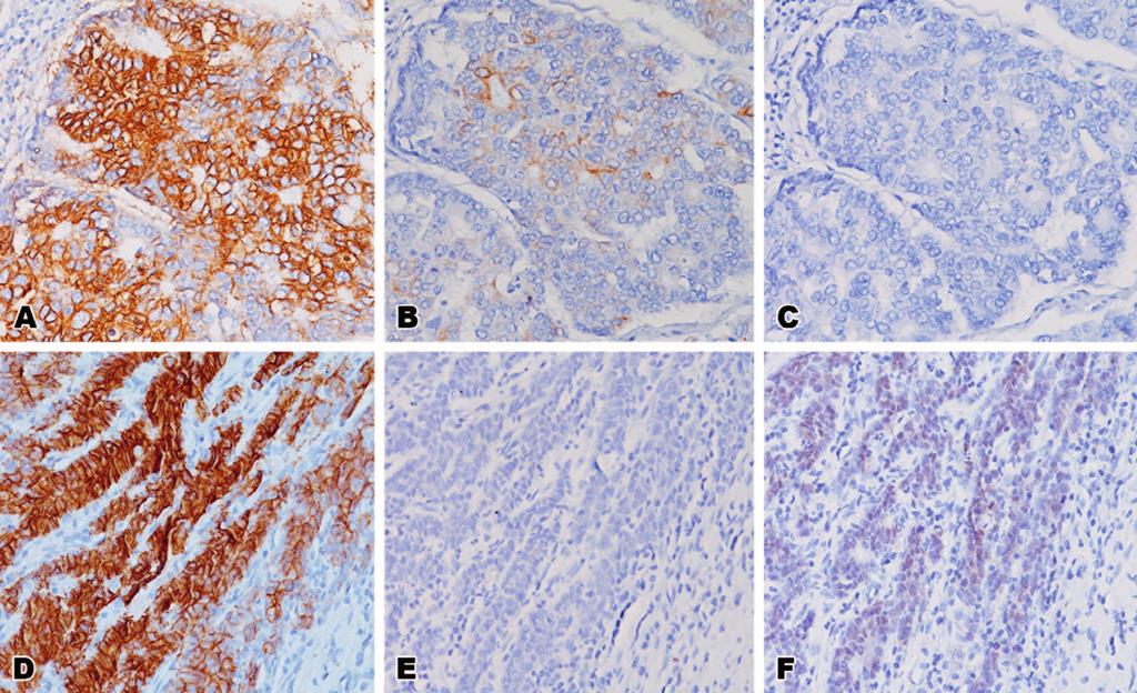 Figure 3. Staining results in metastatic colon adenocarcinoma. A and D, Strong, positive staining was observed in a high percentage of specimens with CDH17.