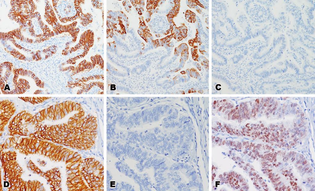 Figure 4. Representative staining results in stomach adenocarcinoma. A, CDH17. B, CK20. C, Negative staining for CDX2. D, CDH17-positive staining at higher magnification.