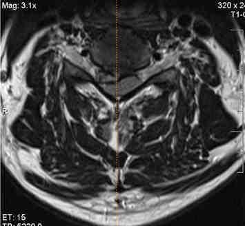 Figure 2 - MRI scan: Right