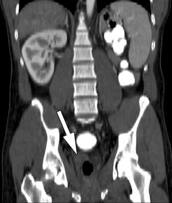 1 32-year-old man with symptoms of appendicitis.