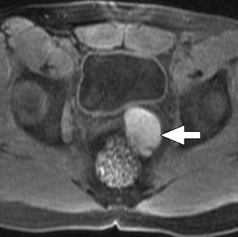 Normal right kidney is visible.