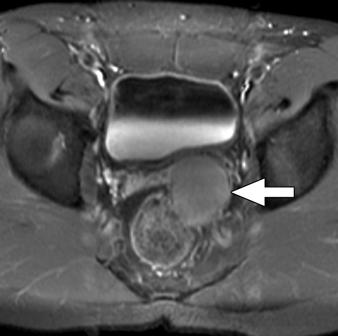 lowattenuation mass posterior to bladder and arising from seminal vesicle.