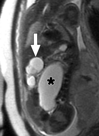 (arrows). Fig. 4 Male fetus at 30 weeks of gestation. MRI was performed for further evaluation of abnormal prenatal sonography.