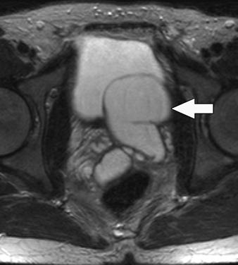 , Coronal reformatted contrast-enhanced CT image shows incidental left renal agenesis and dilated left ureter (arrow)