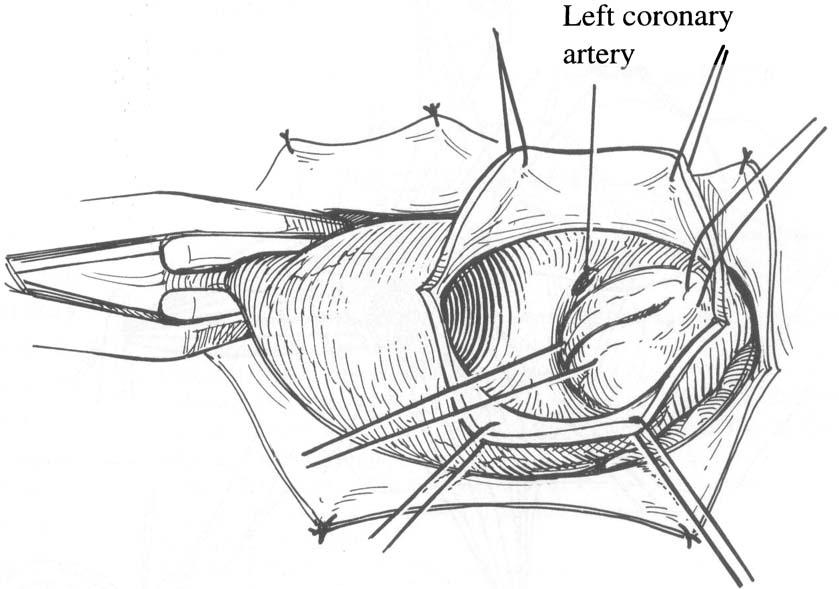 PARASTERNAL APPROACH FOR MIAVS 59 b Left coronary 5 The aorta is cross-clamped with the Fogarty Hydragrip clamp (Baxter Edwards).