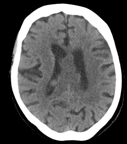 Our patient: Initial Head CT C- axial head CT -Single irregularly lobulated, hypodense mass in the body and splenium of