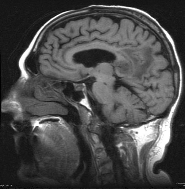 Companion Patient 1: Glioblastoma on Sagittal MRI C- axial head MRI T1WI -Poorly circumscribed,