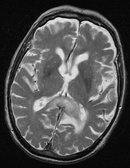 Companion Patient 1: Glioblastoma on Axial MRI C-