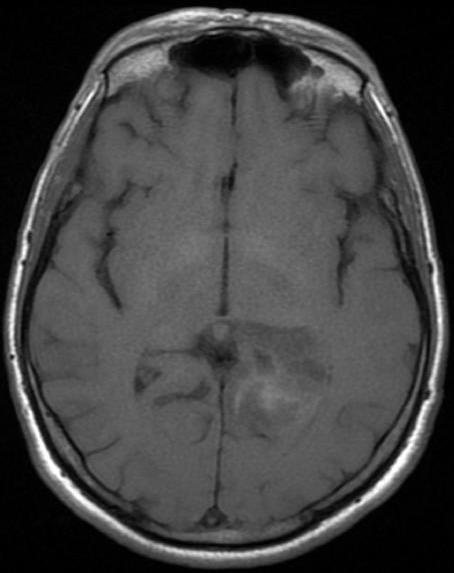 Companion Patient 2: Anaplastic Astrocytoma on T1 MRI C- axial head MRI T1WI