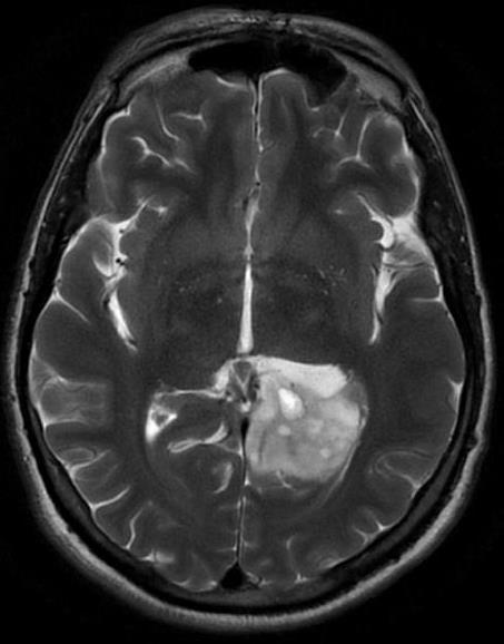 Companion Patient 2: Anaplastic Astrocytoma on T2 MRI C- axial head MRI T2WI -Predominantly increased signal intensity