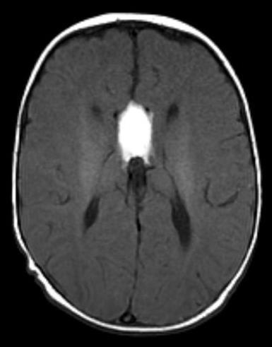 Companion patient 4: Lipoma on Axial MRI C- axial head