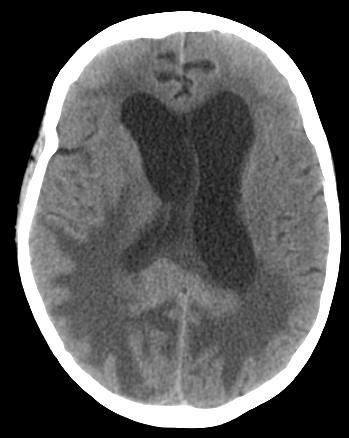 Companion Patient 5: Primary CNS Lymphoma on CT