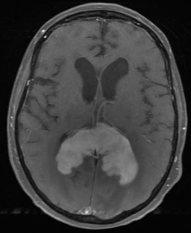 Companion Patient 5: Primary CNS Lymphoma on
