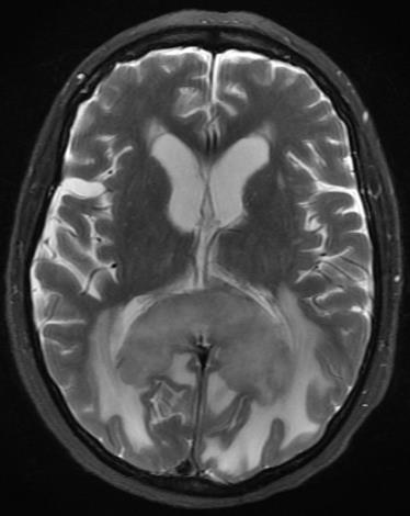 intense enhancement C- axial head MRI T1WI