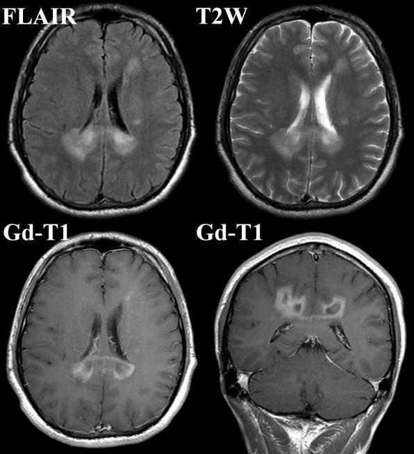 Companion Patient 7: Tumefactive Multiple Sclerosis on MRI -Heterogeneously enhancing lesion in splenium -High signal intensity of lesion -Other white matter lesions