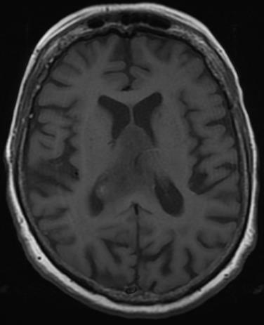 Our Patient: Findings on T1 MRI C- axial head MRI T1WI -Heterogeneous, hypointense mass
