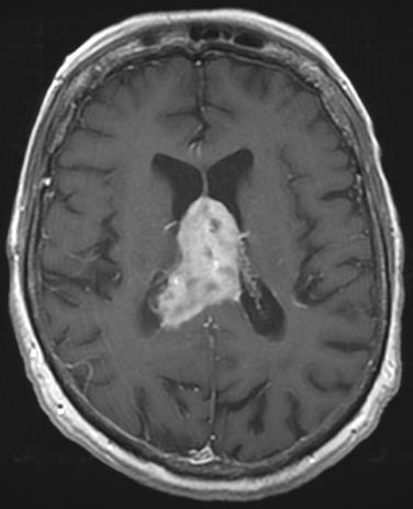 Our Patient: Findings on Axial T1 and T2 MRI C+ axial head MRI