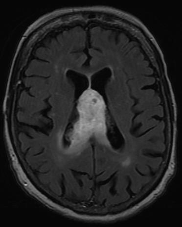 may be necrosis C- axial head MRI T2 FLAIR -Heterogeneous high