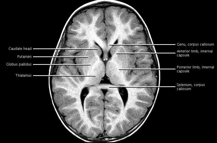 callosum C- axial head MRI T1WI