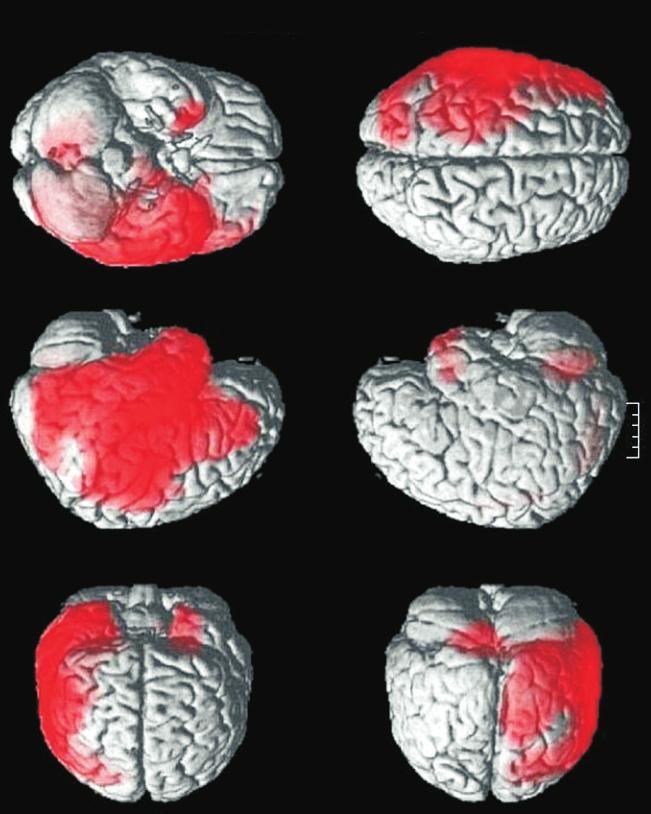 (A) 18 F-fluorodeoxyglocese positron emission tomography (FDG-PET) scans reveal diffuse hypometabolism in the left hemisphere with the exception of the occipital lobe.