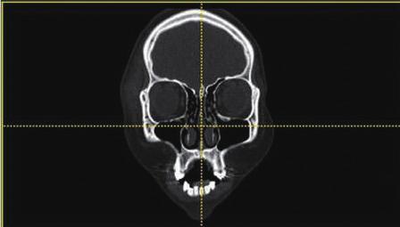 In a radiological study, paranasal sinus (PNS) computed tomography (CT) [8] did not provide a sagittal view; therefore, the sagittal view required reconstruction through additional procedures.