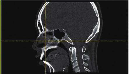 On the other hand, a 3-dimensional (3D) facial bone CT scan, which is often performed in facial plastic surgery, provides sagittal images routinely and can demonstrate excellent views of the nasal