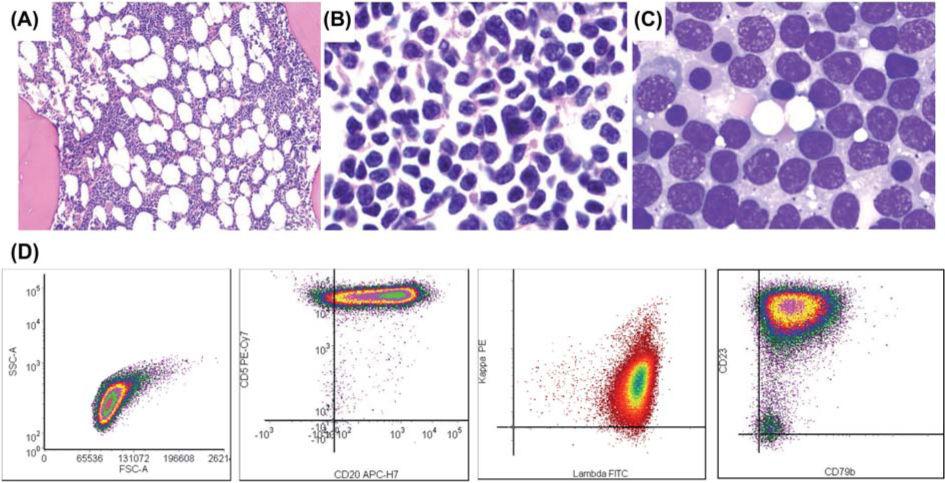 Linden et al. Page 5 Figure 1. Pre-transplant bone marrow sampling. (A, B) H&E stained sections of the trephine biopsy at (A) 10 and (B) 100 oil.