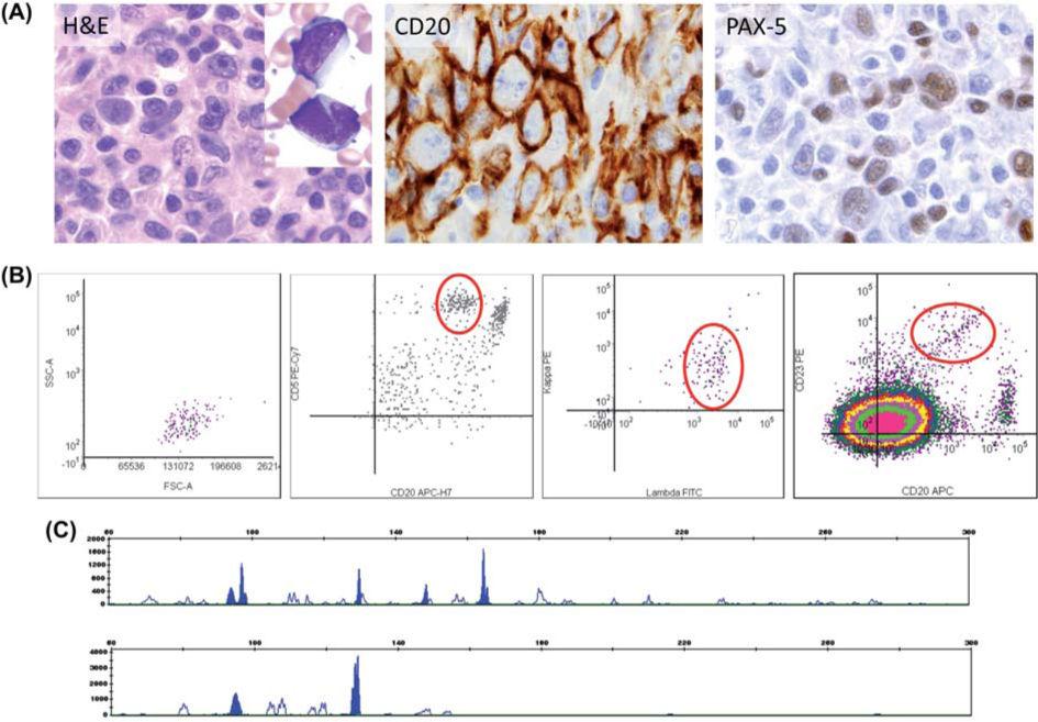 Linden et al. Page 6 Figure 2. Post-transplant bone marrow sampling documenting Richter transformation. (A) Neoplastic cells exhibited prominent nucleoli and vesicular chromatin.