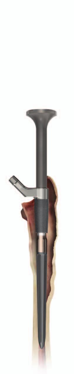 Upon orienting the Proximal Body implant to match the version established during trialling, use finger pressure on the Taper Tamp to engage the Proximal Body implant and Distal Stem implant locking