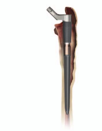 Attach the Torque Wrench assembly to the implant construct by placing the fork of the Torque Wrench Body over the neck of the Proximal Body implant.