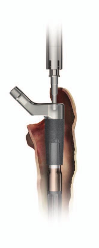 If it becomes necessary to separate the tapers of those implant components a second time, both the Proximal Body and the Distal Stem must