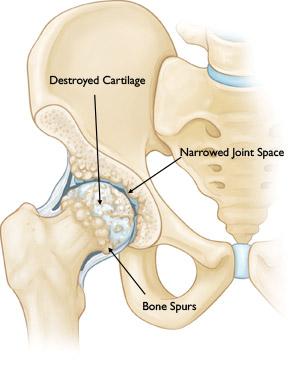 A hip damaged by osteoarthritis. Osteoarthritis of the Hip Animation courtesy Visual Health Solutions, Inc.