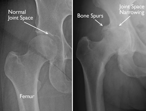 (Left) In this x ray of a normal hip, the space between the ball and socket indicates healthy cartilage. (Right) This x ray of an arthritic hip shows severe loss of joint space and bone spurs.