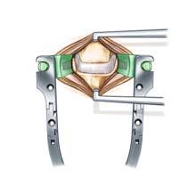 CeSpace Distraction / Discectomy / Preparation of the Endplates The distraction screws are placed in